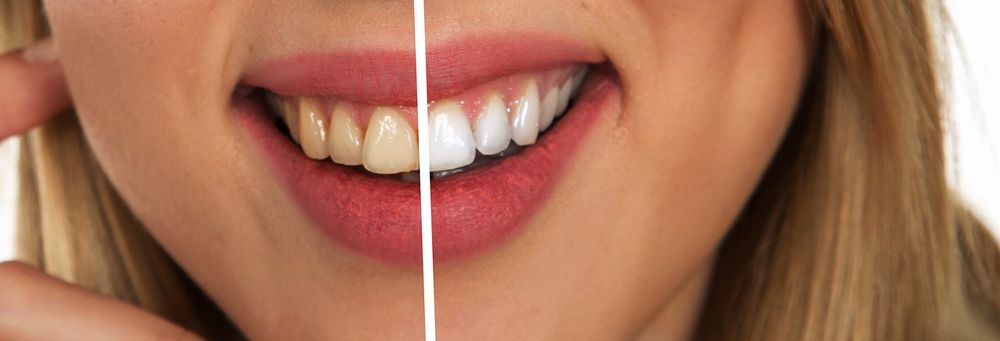 メディカルホワイトで、歯の黄ばみを改善できる
